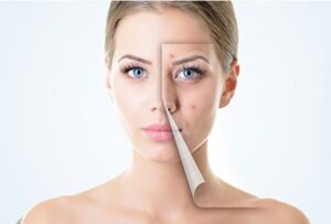 před akné a po léčbě