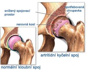 artritida-a-lecba-konopim2