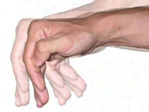 Parkinson a CBD